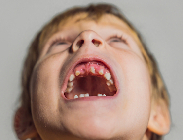 Kids narrow arch dental problem