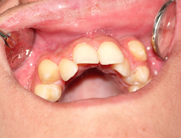 Kids crooked teeth problem