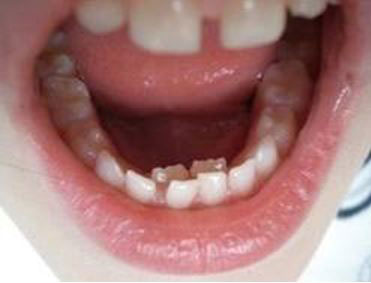 Perm teeth behind baby teeth problem