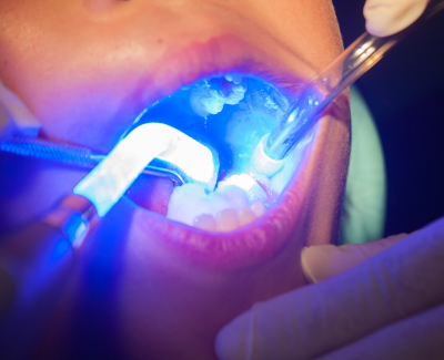 pediatric dentistry sealant procedure